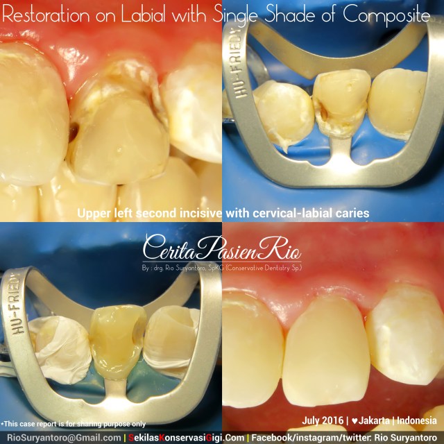 dokter gigi rio suryantoro spesialis konservasi gigi terbaik jakarta RK 22 jul anin