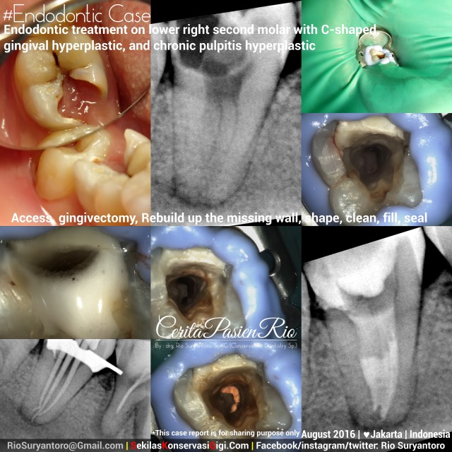 dokter gigi rio suryantoro spesialis konservasi gigi terbaik jakarta PSA 47 AYURI agst