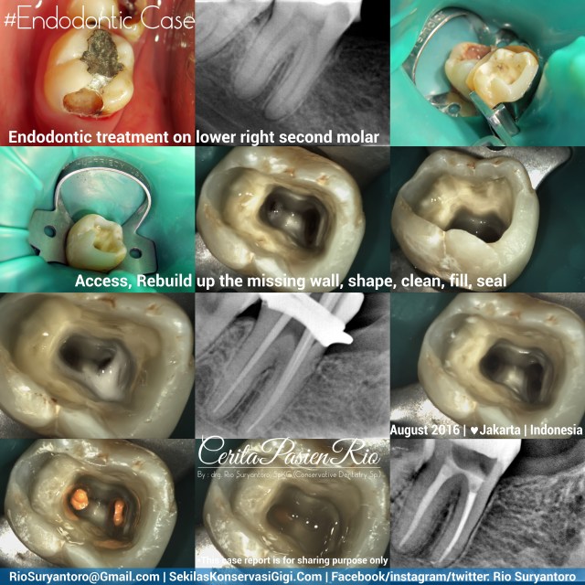 dokter gigi rio suryantoro spesialis konservasi gigi terbaik jakarta PSA 47 Rini slipi