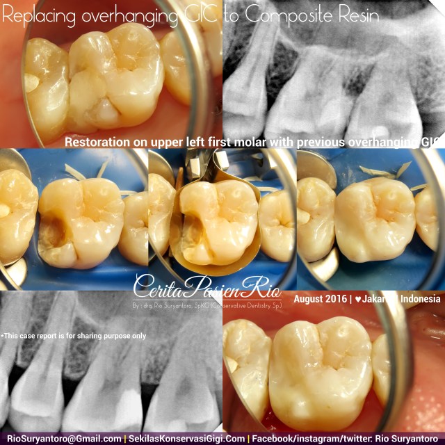 dokter gigi rio suryantoro spesialis konservasi gigi terbaik jakarta RK AF 2 Dini Alker