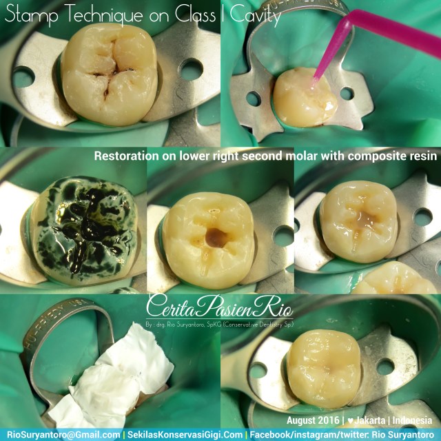 dokter gigi rio suryantoro spesialis konservasi gigi terbaik jakarta RK Stamp Shicil 47 slipi