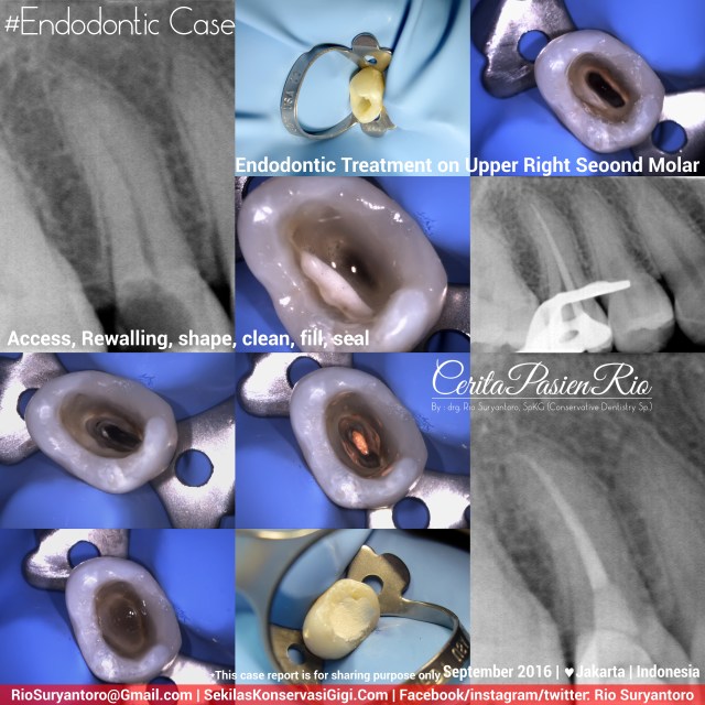 dokter-gigi-rio-spesialis-konservasi-gigi-terbaik-jakarta-indonesia-endodontist-aulia-sept-endo-ok
