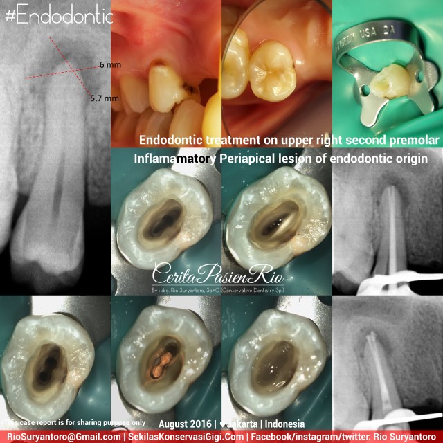 dokter-gigi-rio-spesialis-konservasi-gigi-terbaik-jakarta-indonesia-endodontist-iva-august-slipi