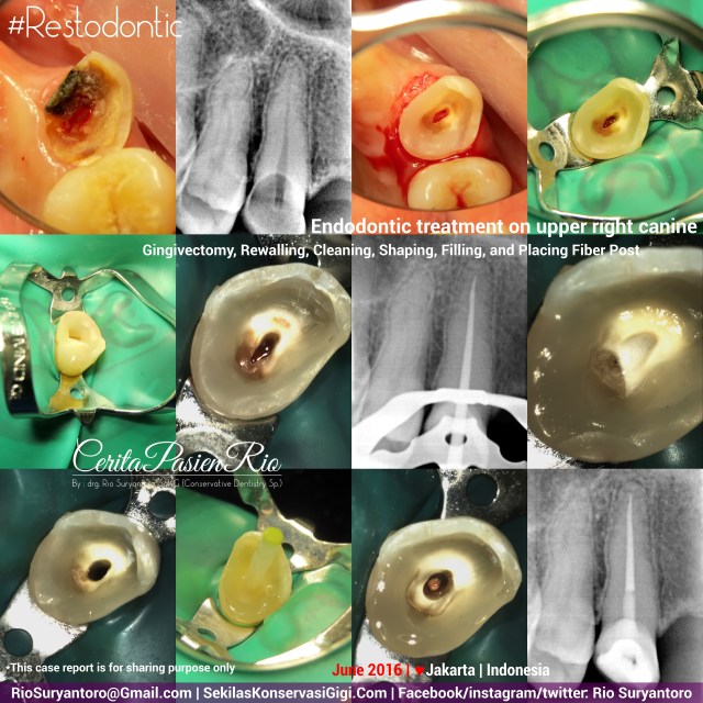 dokter-gigi-rio-spesialis-konservasi-gigi-terbaik-jakarta-indonesia-endodontist-wishnu-juni