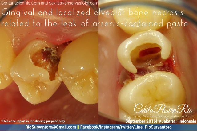 dokter-gigi-rio-suryantoro-spesialis-konservasi-gigi-jakarta-relax-arsen-bocor