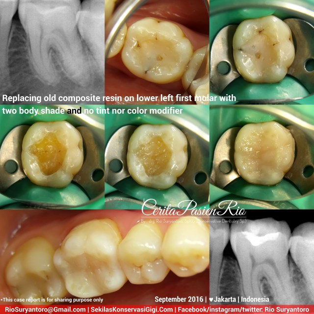 dokter-gigi-rio-suryantoro-spesialis-konservasi-gigi-terbaik-jakarta-post-endo-evi-line-slipi-sept