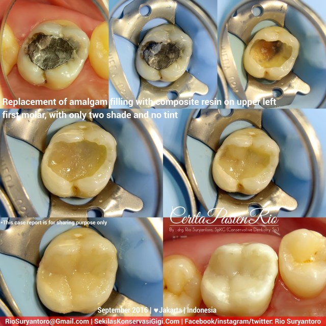 dokter-gigi-rio-suryantoro-spesialis-konservasi-gigi-terbaik-jakarta-post-endo-heldy-sept-alker