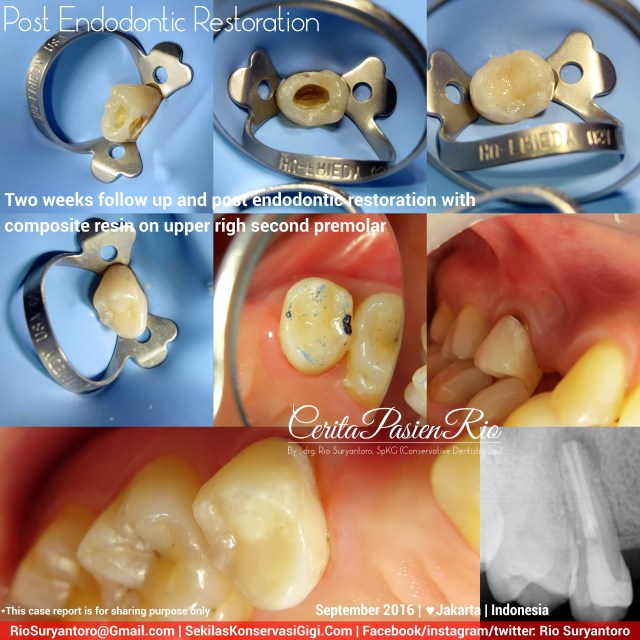 dokter-gigi-rio-suryantoro-spesialis-konservasi-gigi-terbaik-jakarta-post-endo-iva-slipi-sept