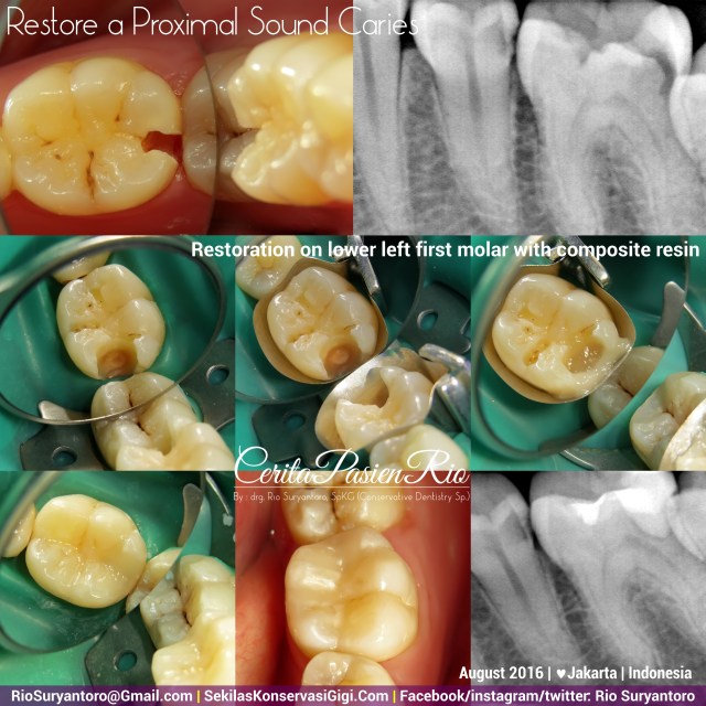 dokter-gigi-rio-suryantoro-spesialis-konservasi-gigi-terbaik-jakarta-resin-komposit-aulia-36-slipi