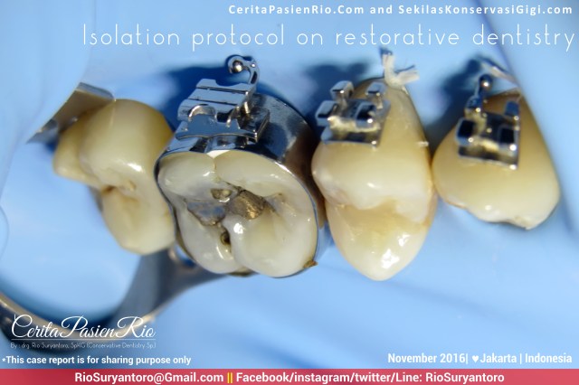 dokter-gigi-rio-suryantoro-spesialis-konservasi-gigi-jakarta-relax-oct-livvy-alker