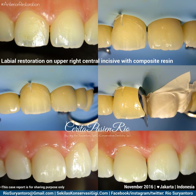 dokter-gigi-rio-suryantoro-spesialis-konservasi-gigi-terbaik-jakarta-koas-alker-11